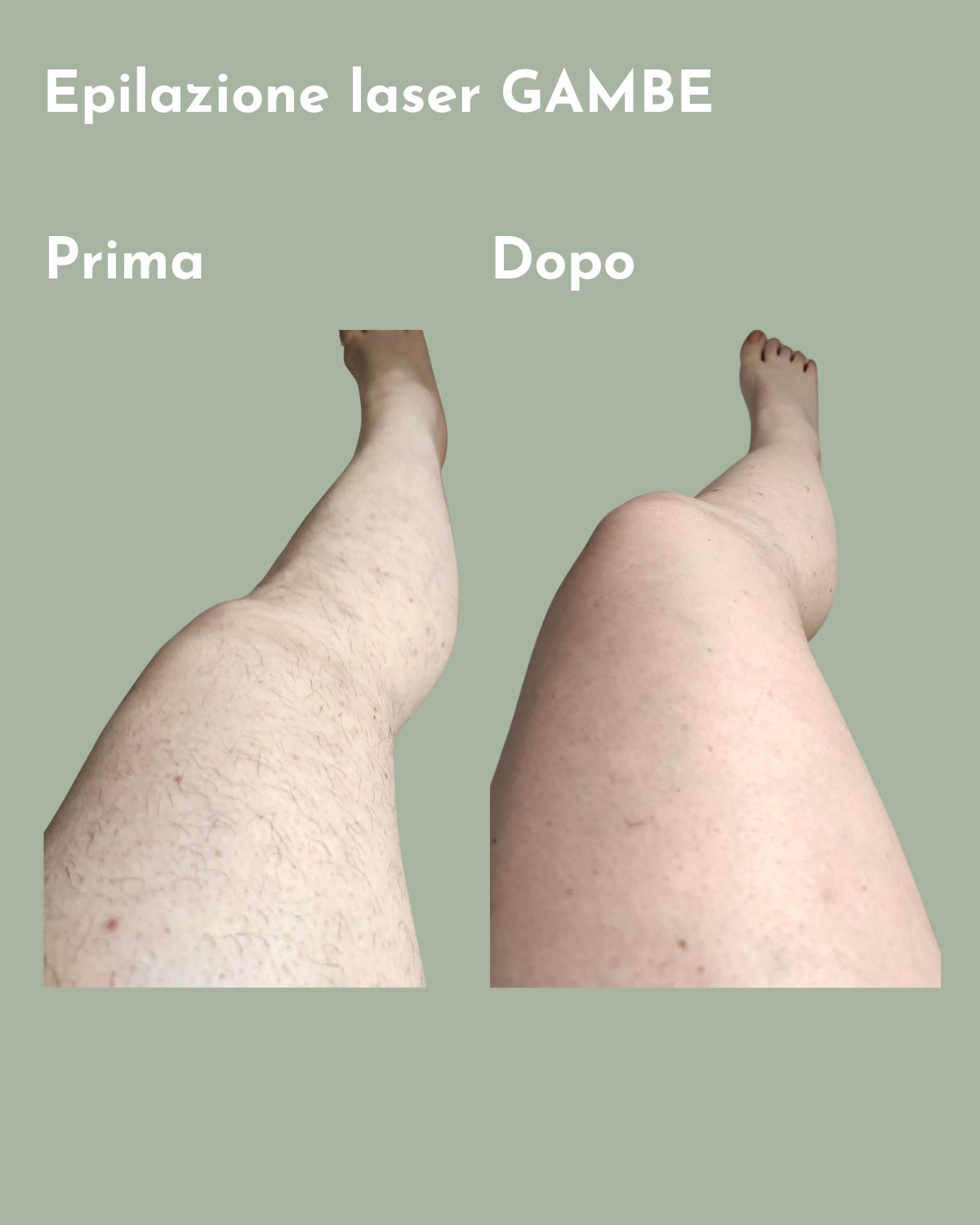 Il prima e il dopo di un percorso di epilazione laser gambe. presso il centro estetico Alma a Jesolo. La cliente ha risolto il suo problema di irsutismo