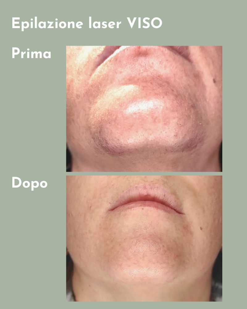 Il prima e il dopo di un percorso di epilazione laser nella zona del mento, presso il centro estetico Alma a Jesolo. La cliente ha definitivamente risolto il suo problema di irsutismo.