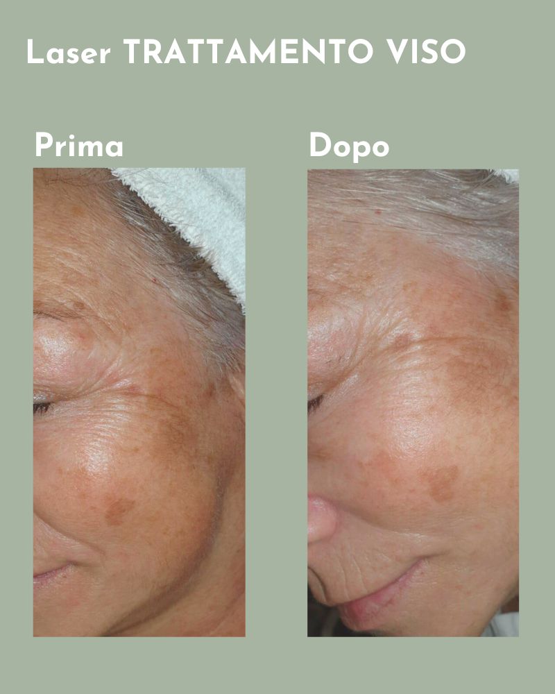 Il prima e il dopo di un trattamento laser con foto bio stimolazione del viso. La cliente ha attenuato le macchie causate dall’esposizione solare.